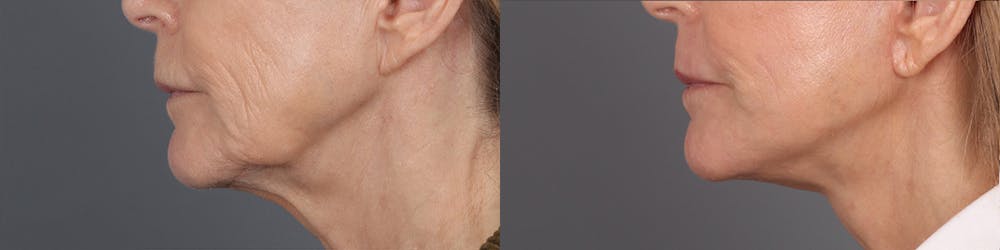 Face & Neck Lift Before & After Gallery - Patient 357281 - Image 2