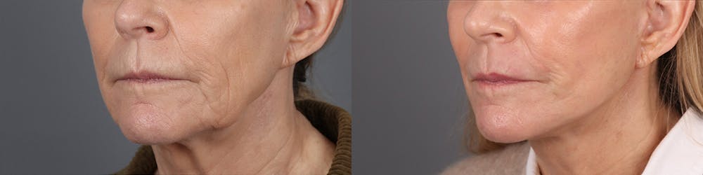 Face & Neck Lift Before & After Gallery - Patient 357281 - Image 3