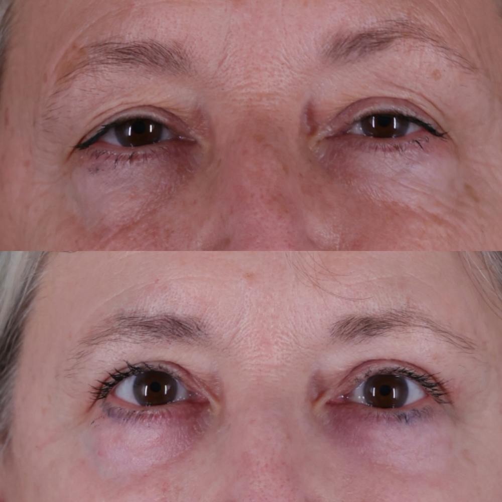 Upper Blepharoplasty Before & After Gallery - Patient 212007 - Image 1