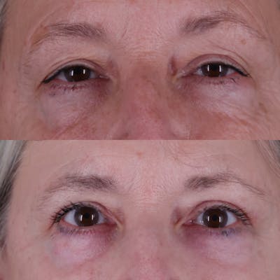 Upper Blepharoplasty Before & After Gallery - Patient 212007 - Image 1