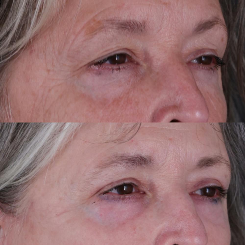 Upper Blepharoplasty Before & After Gallery - Patient 212007 - Image 2