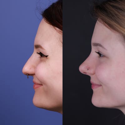 Rhinoplasty Before & After Gallery - Patient 178916 - Image 2