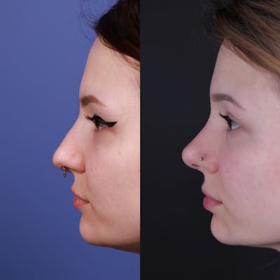 Rhinoplasty Before & After Gallery - Patient 178916 - Image 1