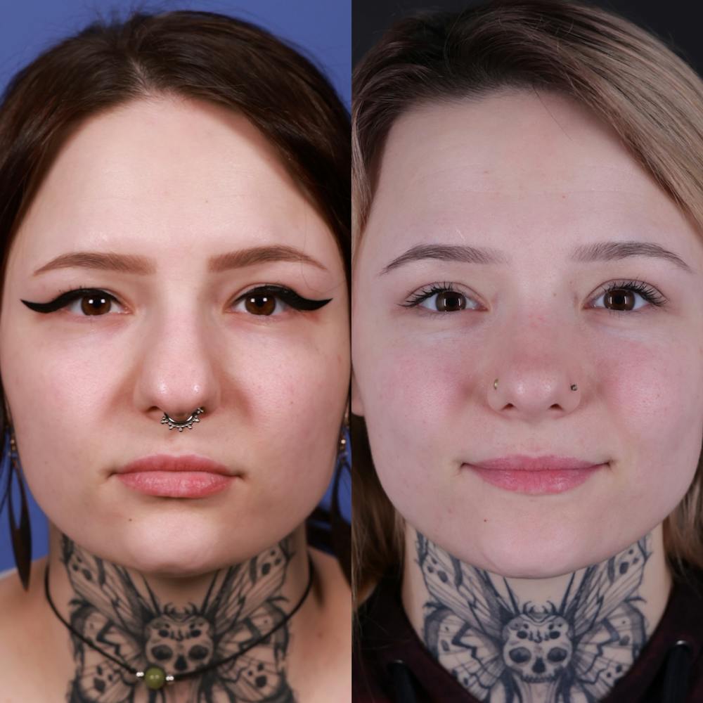Rhinoplasty Before & After Gallery - Patient 178916 - Image 4