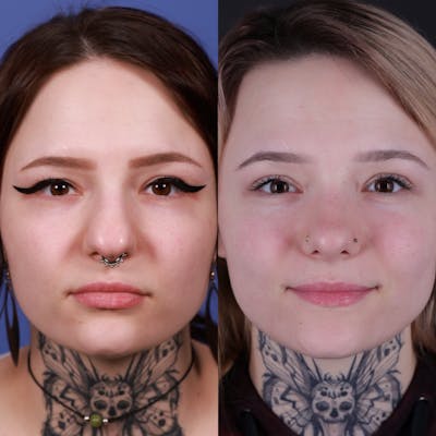 Rhinoplasty Before & After Gallery - Patient 178916 - Image 4