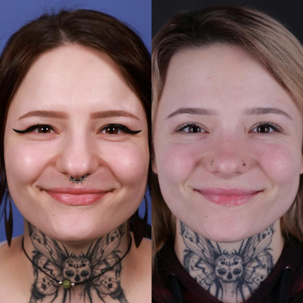 Rhinoplasty Before & After Gallery - Patient 178916 - Image 5