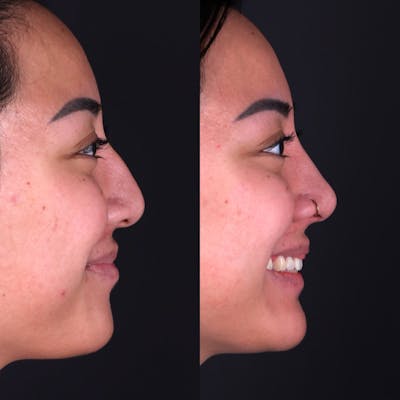 Rhinoplasty Before & After Gallery - Patient 986743 - Image 2