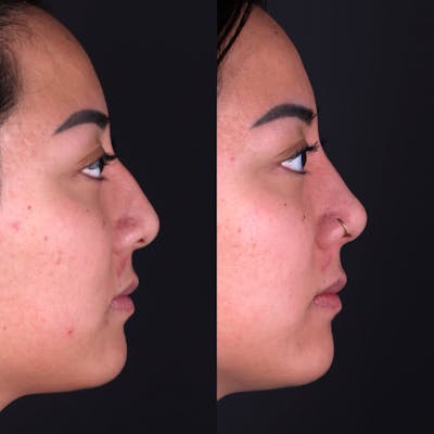 Rhinoplasty Before & After Gallery - Patient 986743 - Image 1