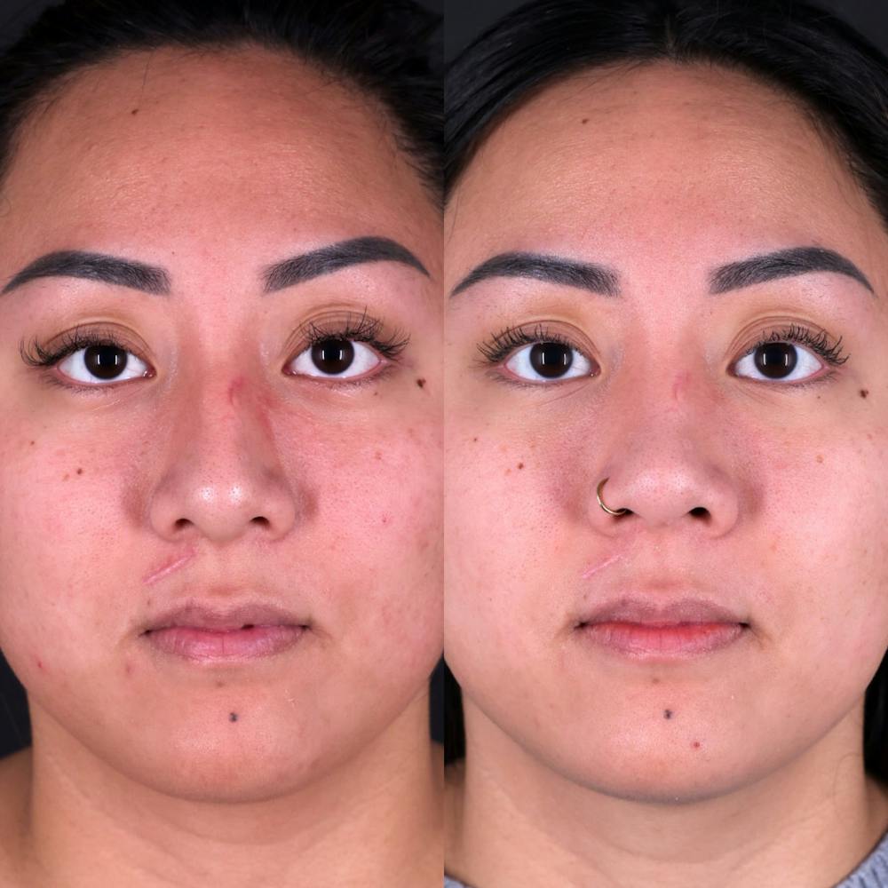 Rhinoplasty Before & After Gallery - Patient 986743 - Image 4