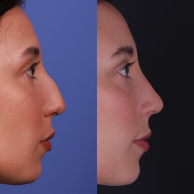 Rhinoplasty Before & After Gallery - Patient 170979 - Image 1