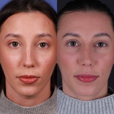 Rhinoplasty Before & After Gallery - Patient 170979 - Image 4