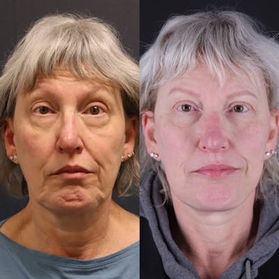 Face & Neck Lift Before & After Gallery - Patient 393861 - Image 4