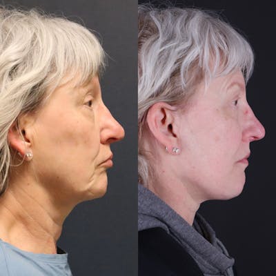 Face & Neck Lift Before & After Gallery - Patient 393861 - Image 2