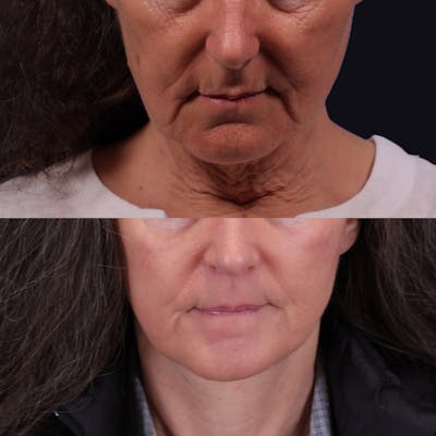 Face & Neck Lift Before & After Gallery - Patient 343054 - Image 4