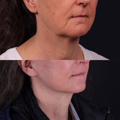 Face & Neck Lift Before & After Gallery - Patient 343054 - Image 1