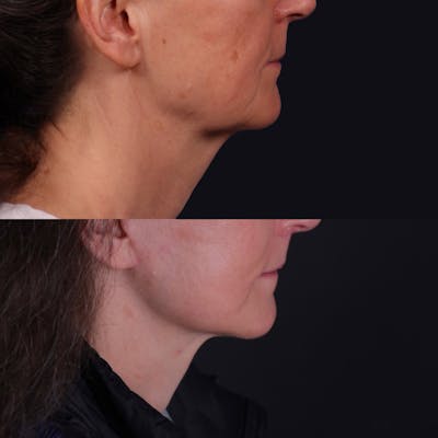 Face & Neck Lift Before & After Gallery - Patient 343054 - Image 2