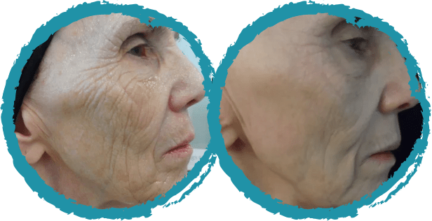 before and after microneedling in NYC