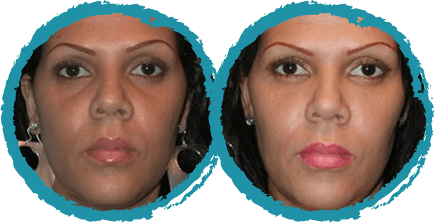 Injectable Before and After Photo