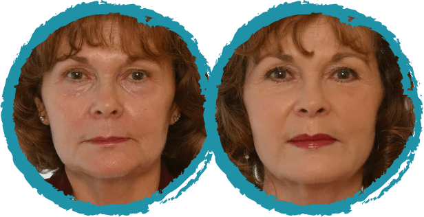 Injectable Before and After Photo