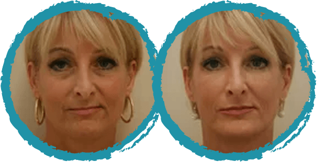 Injectable Before and After Photo