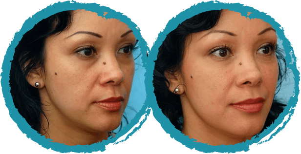 Injectable Before and After Photo