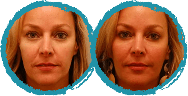 Before and After Injectables