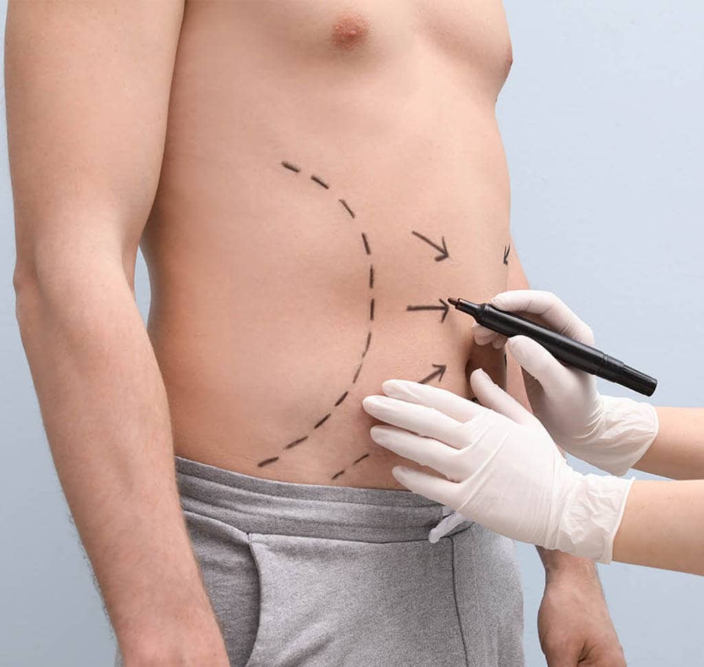 Man with drawing on abdomen where VASER lipo will be performed