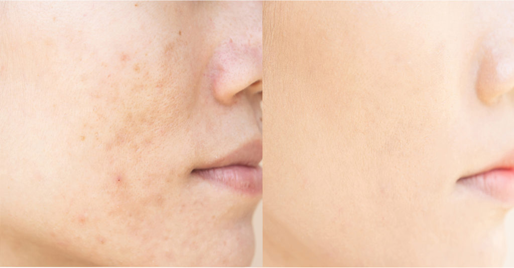 why do acne scars form?