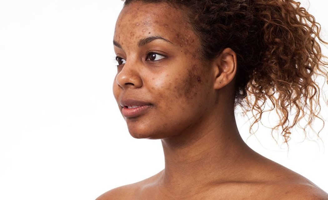 Alinea Medical Spa Acne Scar & Laser Skin Care Blog | Deep Acne Scars: Prevention Tips and Treatment Guide