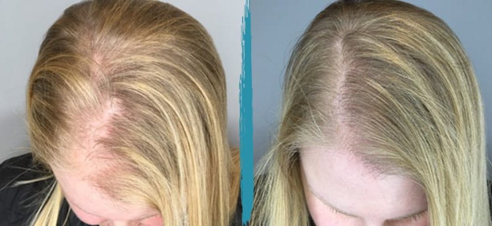 PRP Hair Loss Treatments Before & After Gallery - Patient 18616195 - Image 1