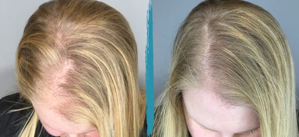 Before and After PRP Hair Restoration in NYC