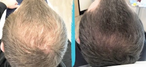 Before and After PRP Hair Restoration in NYC