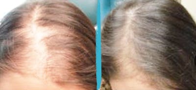 PRP Hair Loss Treatments Before & After Gallery - Patient 18616197 - Image 1