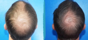 Before and After PRP Hair Restoration in NYC