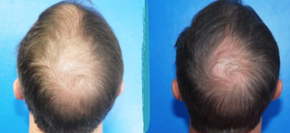 PRP Hair Loss Treatments Before & After Gallery - Patient 18616198 - Image 1