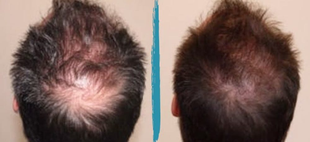 Patient 18616199 | PRP Hair Loss Treatments Before & After Photos | Alinea Medical Spa Acne Scar & Laser Skin Care Patient 18616199 | PRP Hair Loss Treatments Before & After Photos | Alinea Medical Spa Acne Scar & Laser Skin Care