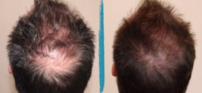 PRP Hair Loss Treatments Before & After Gallery - Patient 18616199 - Image 1