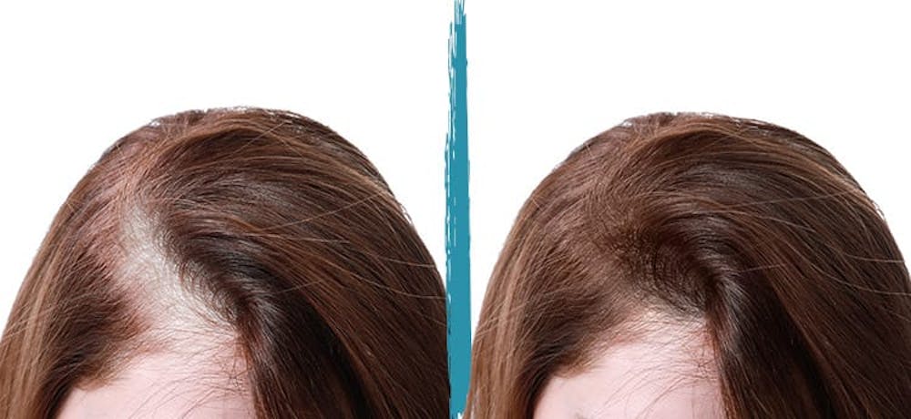 PRP Hair Loss Treatments Before & After Gallery - Patient 18616200 - Image 1