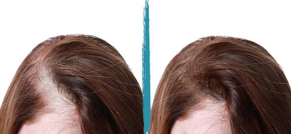 Patient 18616200 | PRP Hair Loss Treatments Before & After Photos | Alinea Medical Spa Acne Scar & Laser Skin Care Patient 18616200 | PRP Hair Loss Treatments Before & After Photos | Alinea Medical Spa Acne Scar & Laser Skin Care