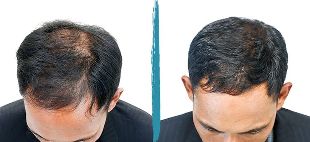 PRP Hair Loss Treatments Before & After Gallery - Patient 18616201 - Image 1