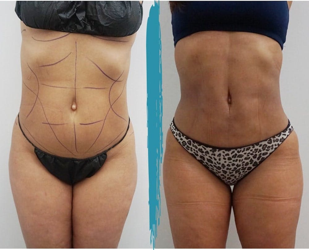 Vaser Lipo Before & After Gallery - Patient 18616206 - Image 1