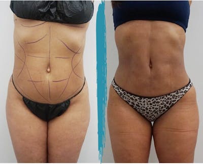 Vaser Lipo Before & After Gallery - Patient 18616206 - Image 1