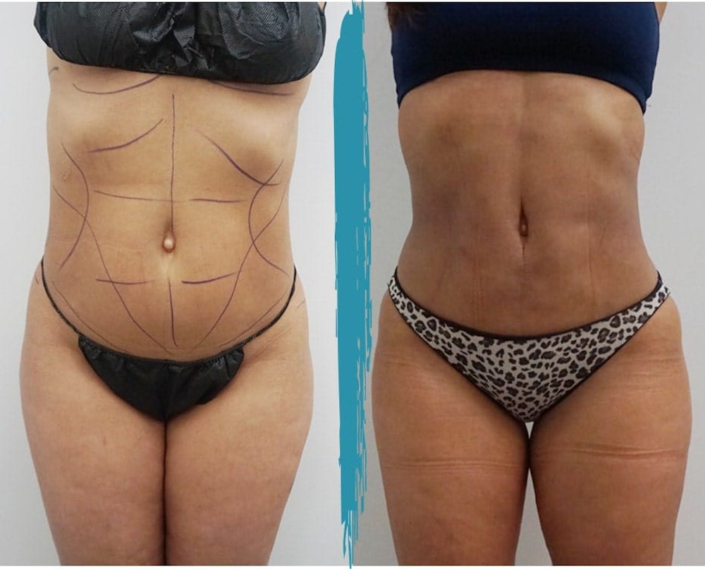 VASER Lipo results in NYC