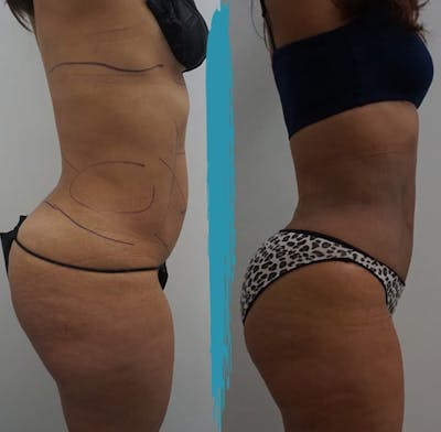 Vaser Lipo Before & After Gallery - Patient 18616205 - Image 1