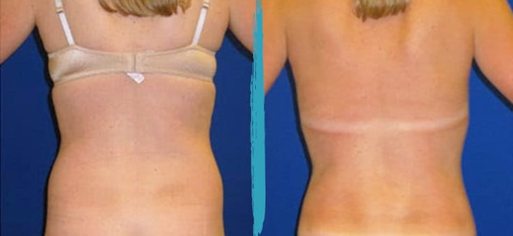 Before and after photos of body contouring patient in NYC