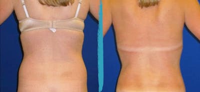 Vaser Lipo Before & After Gallery - Patient 18616208 - Image 1