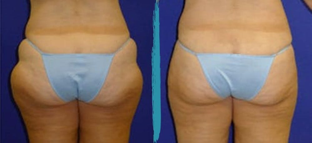 Vaser Lipo Before & After Gallery - Patient 18616209 - Image 1