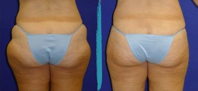Vaser Lipo Before & After Gallery - Patient 18616209 - Image 1