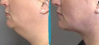 Vaser Lipo Before & After Gallery - Patient 18616210 - Image 1