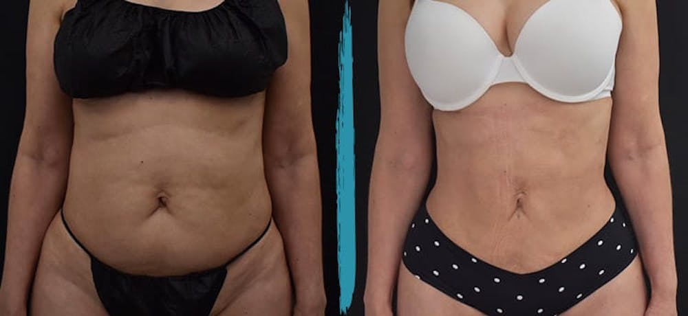 Vaser Lipo Before & After Gallery - Patient 18616211 - Image 1